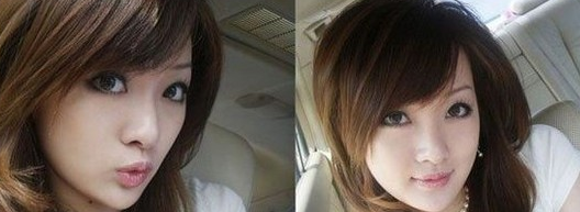 Vline+面部填充  飽滿起來更加年輕美麗 - 珍美網(wǎng)