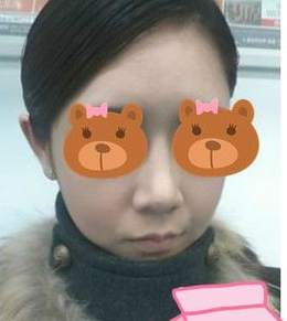 隆鼻整形 使自己看到美麗的自己
