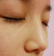 隆鼻整形 做勇敢美麗的自己
