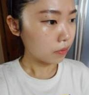 割雙眼皮+墊鼻子 越來越愛自己啦 - 珍美網(wǎng)