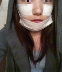 顴骨整形 變小臉更加可愛(ài)漂亮 - 珍美網(wǎng)
