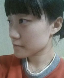 【雙顎手術(shù)和面部輪廓術(shù)】 自信美麗讓我相信生活的美好 - 珍美網(wǎng)