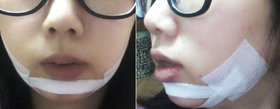 假體墊下巴  有下巴的感覺就是美的不要不要 - 珍美網(wǎng)