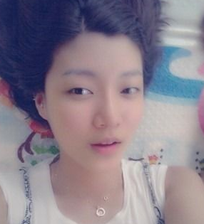 自體脂肪豐額頭 讓面部整體看起來(lái)更加氣質(zhì)美麗