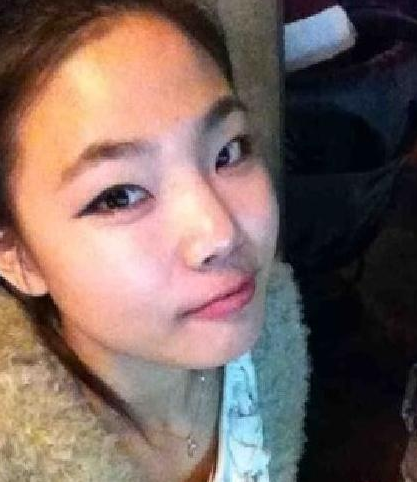 雙眼皮手術  原來變美麗這么簡單啊 - 珍美網