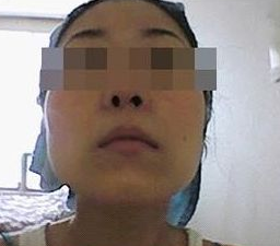 吸脂瘦臉 讓五官更加立體精致 - 珍美網(wǎng)