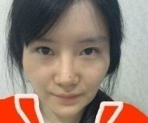【下巴矯正+前顴骨磨骨+下顎前凸整形】感覺自己越來越美麗了 - 珍美網(wǎng)