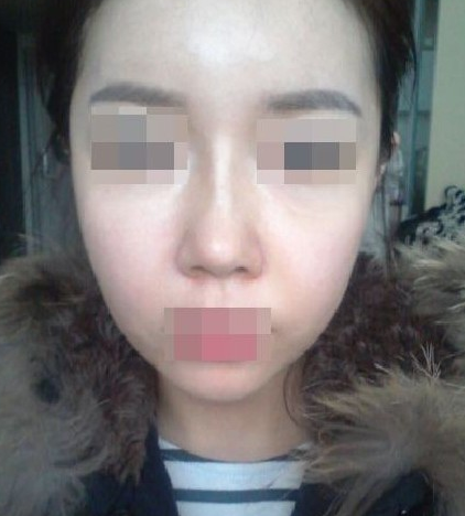 面部整形  更加漂亮有氣質(zhì)