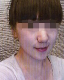 瘦臉吸脂  驚艷了自己的眼睛怎么這么美 - 珍美網(wǎng)