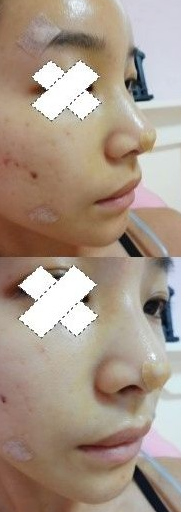 隆鼻手術(shù)  更成熟更有魅力了 - 珍美網(wǎng)