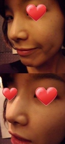 隆鼻手術(shù)  更成熟更有魅力了