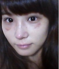 隆鼻手術(shù)  讓我更加充滿(mǎn)信心 - 珍美網(wǎng)