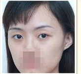 注射玻尿酸  熊貓眼也可以消的干凈 - 珍美網(wǎng)