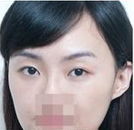 注射玻尿酸  熊貓眼也可以消的干凈 - 珍美網(wǎng)