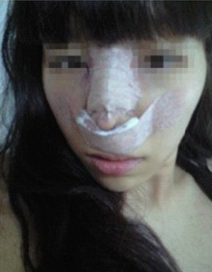 駝峰鼻整形  整體面部都很精致了 - 珍美網(wǎng)