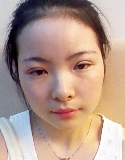 雙眼皮手術(shù) 我也可以擁有明亮大眼睛啦 - 珍美網(wǎng)