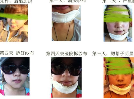 下頜角手術(shù) 讓我比之前的臉型更加漂亮 - 珍美網(wǎng)