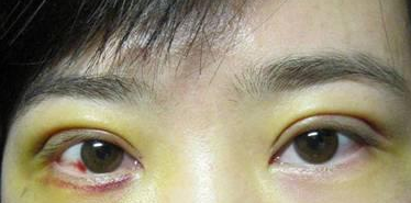 雙眼皮手術(shù) 發(fā)現(xiàn)雙眼皮的魅力好大 - 珍美網(wǎng)
