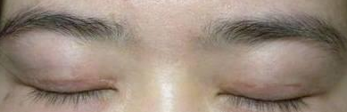 雙眼皮手術(shù) 發(fā)現(xiàn)雙眼皮的魅力好大 - 珍美網(wǎng)