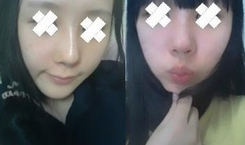 駝峰鼻整形 提升個人氣質杠杠的 - 珍美網