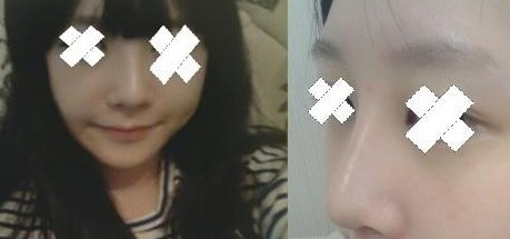 駝峰鼻整形 提升個人氣質杠杠的 - 珍美網