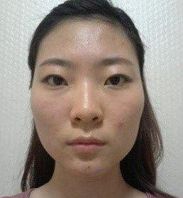 面部整形 讓我幸?？鞓访恳惶?- 珍美網(wǎng)