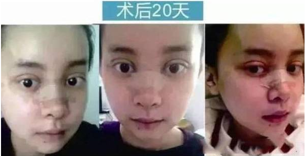 重慶女子花百萬整成anglababy  網(wǎng)友驚呼：太像了！ - 珍美網(wǎng)