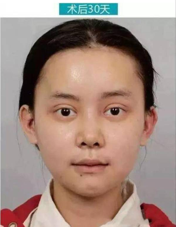 重慶女子花百萬整成anglababy  網(wǎng)友驚呼：太像了！ - 珍美網(wǎng)