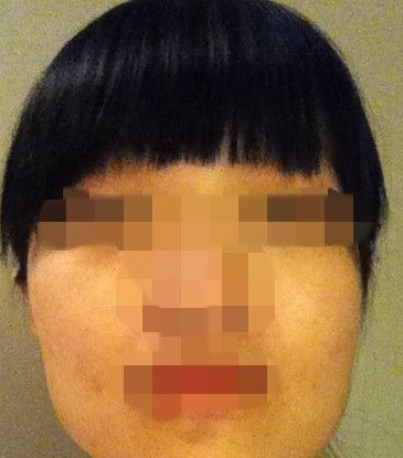 下頜角整形  擁有小臉的我也是很美麗的 - 珍美網(wǎng)