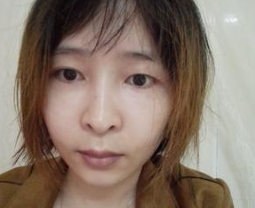 廣州韓妃醫(yī)學(xué)美容門(mén)診部曾繁茂醫(yī)生豐蘋(píng)果肌案例：豐蘋(píng)果肌 - 珍美網(wǎng)