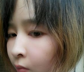 廣州韓妃醫(yī)學(xué)美容門(mén)診部曾繁茂醫(yī)生豐蘋(píng)果肌案例：豐蘋(píng)果肌 - 珍美網(wǎng)