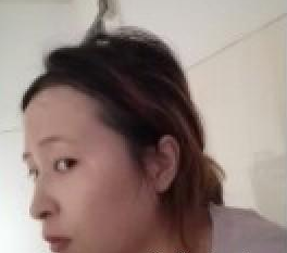 廣州韓妃醫(yī)學(xué)美容門(mén)診部曾繁茂醫(yī)生豐蘋(píng)果肌案例：豐蘋(píng)果肌 - 珍美網(wǎng)