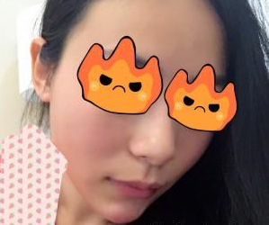 玻尿酸面部填充 讓我更加美麗 - 珍美網(wǎng)