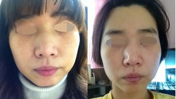青島永緣韓美整形美容診所李太卿醫(yī)生美白案例：美白美容 - 珍美網(wǎng)