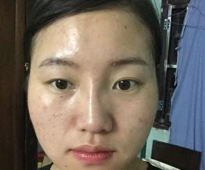 蘇州工業(yè)園區(qū)瑞芙臣醫(yī)療美容診所徐增亮醫(yī)生豐全臉案例：面部填充 - 珍美網(wǎng)