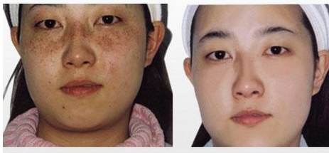 彩光祛斑價格受哪些因素影響