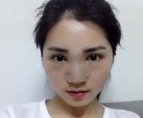 隆鼻整形  我才發(fā)現(xiàn)自己的美越來越驚艷了 - 珍美網(wǎng)