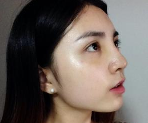 隆鼻整形  我才發(fā)現(xiàn)自己的美越來越驚艷了 - 珍美網(wǎng)