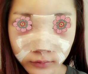 假體隆鼻整形 從來沒這么自信過 - 珍美網(wǎng)