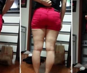 大腿吸脂 擁有細(xì)長的腿不是問題的 - 珍美網(wǎng)