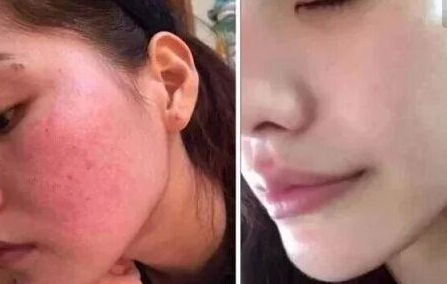 去紅血絲的美容方式有哪些?