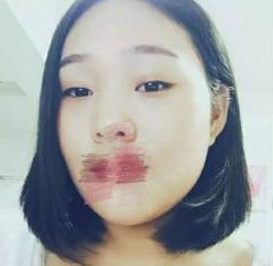 雙眼皮手術(shù) 一閃一閃的大眼睛我值得擁有 - 珍美網(wǎng)
