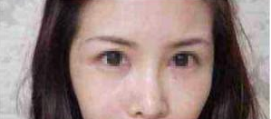 注射豐臥蠶 怎么樣都很美 - 珍美網