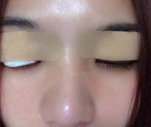 北京圣嘉新醫(yī)療美容門診部朱昊醫(yī)生割雙眼皮案例：實(shí)現(xiàn)美麗的自己 - 珍美網(wǎng)