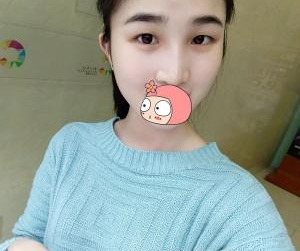 隆鼻手術(shù)  讓我氣質(zhì)越來越好啦 - 珍美網(wǎng)