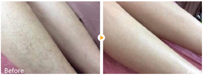 半導(dǎo)體激光脫毛有什么效果