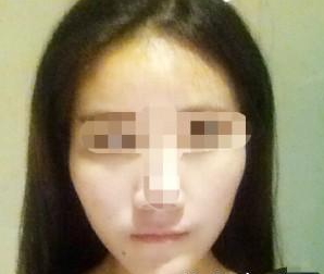 武漢伊美馨醫(yī)療美容門診部黃蕾醫(yī)生墊下巴案例：今天終于去打玻尿 - 珍美網(wǎng)