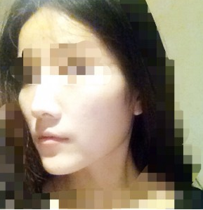 武漢伊美馨醫(yī)療美容門診部黃蕾醫(yī)生墊下巴案例：今天終于去打玻尿 - 珍美網(wǎng)