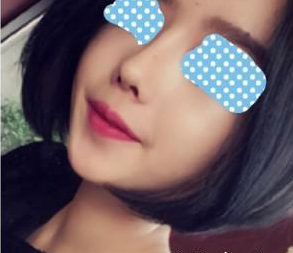 北京歐揚(yáng)醫(yī)療美容門診部薄濱醫(yī)生隆鼻案例：玻尿酸隆鼻 - 珍美網(wǎng)