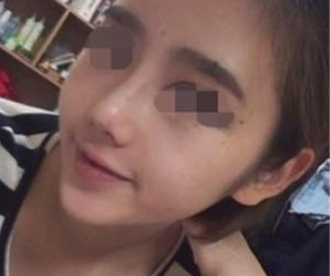 北京歐揚(yáng)醫(yī)療美容門診部薄濱醫(yī)生隆鼻案例：玻尿酸隆鼻 - 珍美網(wǎng)